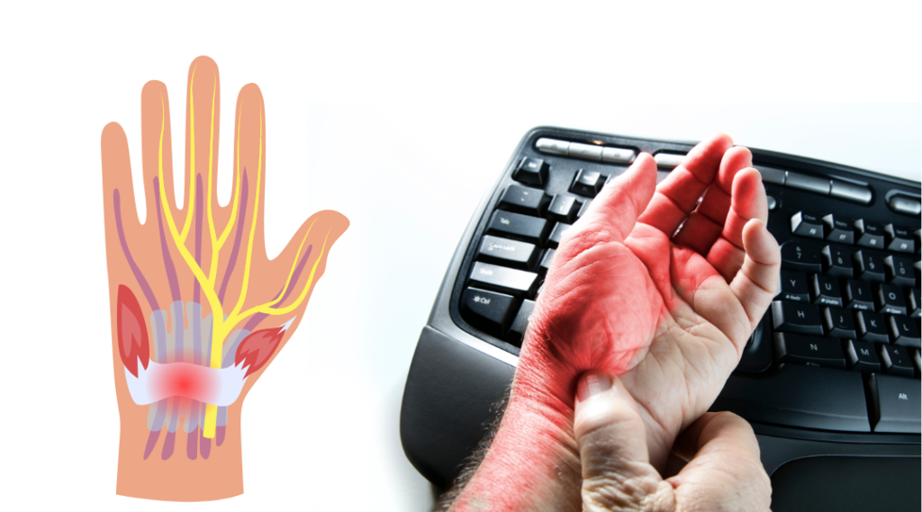 Carpal Tunnel Syndrome (CTS) is a prevalent condition characterized by numbness, tingling, and weakness in the hand and arm. However, it's important to recognize that there are other conditions with similar symptoms that can often be misdiagnosed as CTS. Understanding these conditions is crucial for accurate diagnosis and appropriate treatment. 1. Cubital Tunnel Syndrome Cubital Tunnel Syndrome (CuTS) is a condition caused by compression or irritation of the ulnar nerve as it passes through the cubital tunnel, located on the inner side of the elbow. This nerve compression can lead to symptoms similar to those of CTS, such as tingling, numbness, and weakness in the hand and fingers. Differentiating Factors: Location of Symptoms: While CTS primarily affects the thumb, index, and middle fingers, CuTS typically causes symptoms in the ring and little fingers. Provocative Tests: Specific tests, such as Tinel's sign (tapping over the ulnar nerve at the elbow) and the elbow flexion test, can help diagnose CuTS. Night Symptoms: Unlike CTS, where symptoms often worsen at night, CuTS may cause symptoms when the elbow is bent during sleep. Treatment: Splinting: Similar to CTS, wearing a splint to keep the elbow straight at night can alleviate symptoms. Physical Therapy: Exercises to improve elbow flexibility and nerve gliding exercises can help reduce compression on the ulnar nerve. Steroid Injections: Corticosteroid injections around the ulnar nerve may provide temporary relief from symptoms. Surgery: In severe cases, surgical intervention may be necessary to relieve pressure on the ulnar nerve. 2. Thoracic Outlet Syndrome Thoracic Outlet Syndrome (TOS) encompasses a group of disorders caused by compression of the nerves and blood vessels passing through the thoracic outlet, located between the neck and shoulder. This compression can result in symptoms resembling those of CTS, including hand and arm numbness, tingling, and weakness. Differentiating Factors: Distribution of Symptoms: While CTS primarily affects the hand and wrist, TOS can cause symptoms that radiate into the arm, shoulder, and even the neck. Associated Symptoms: TOS may present with additional symptoms such as neck pain, shoulder pain, and arm swelling. Postural Provocation: Symptoms of TOS may worsen with certain arm positions or activities, such as reaching overhead or carrying heavy objects. Treatment: Physical Therapy: Strengthening exercises focusing on the neck, shoulder, and upper back muscles can help improve posture and reduce compression on the nerves and blood vessels. Postural Modification: Avoiding activities or positions that exacerbate symptoms can alleviate discomfort. Medication: Nonsteroidal anti-inflammatory drugs (NSAIDs) or muscle relaxants may provide temporary relief from pain and discomfort. Surgery: In cases where conservative measures fail to alleviate symptoms, surgical intervention to release compression on the affected nerves or blood vessels may be necessary. Conclusion While Carpal Tunnel Syndrome is a well-known and frequently diagnosed condition, it's essential to recognize that other conditions can mimic its symptoms. Cubital Tunnel Syndrome and Thoracic Outlet Syndrome are two such conditions that often present with similar complaints of hand and arm numbness, tingling, and weakness. Proper diagnosis, based on clinical evaluation and diagnostic tests, is crucial for effective management and treatment. By understanding the distinguishing features of these conditions, healthcare professionals can provide patients with accurate diagnoses and appropriate interventions, ultimately improving outcomes and quality of life.