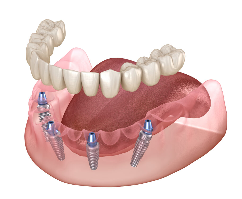 What Is All-on-4 and How Does It Transform Your Smile?